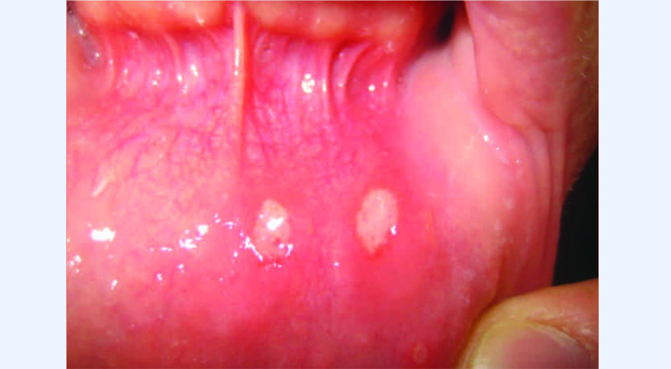 Treatment for Mouth Ulcer Bangalore Doctor for Mouth Ulcer
