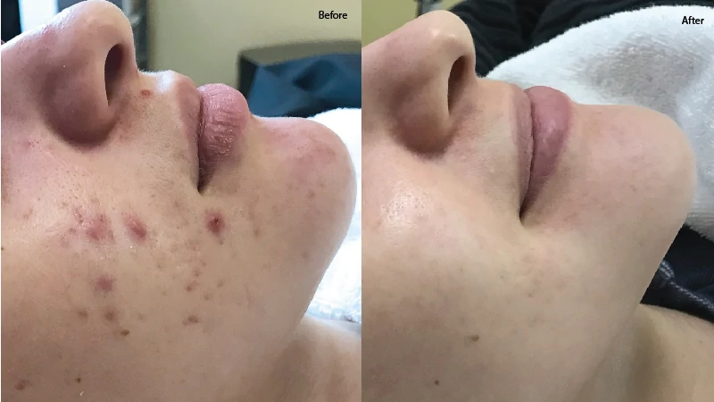 Acne Surgery Image