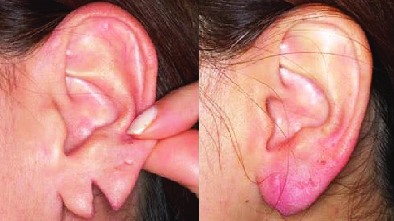 Earlobe Repair - Arumeen Aaesthetic Centere