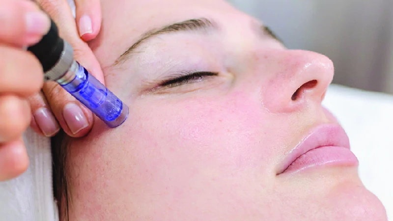 micro needling image