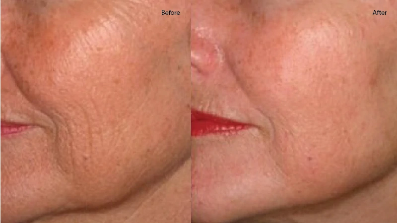 prp for skin tightening image