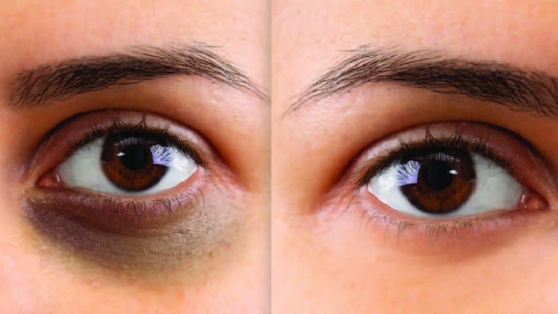 Benefits and Side-effects of Under-Eye PRP Treatment Benefits and Side-effects of Under-Eye PRP Treatment