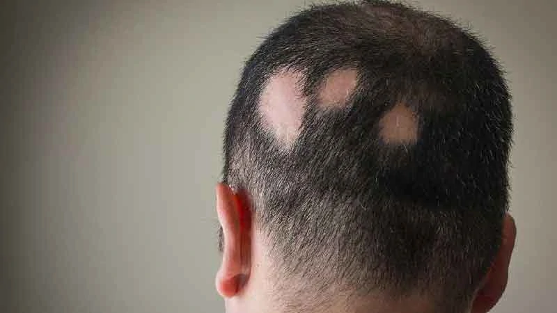 Alopecia Areata image