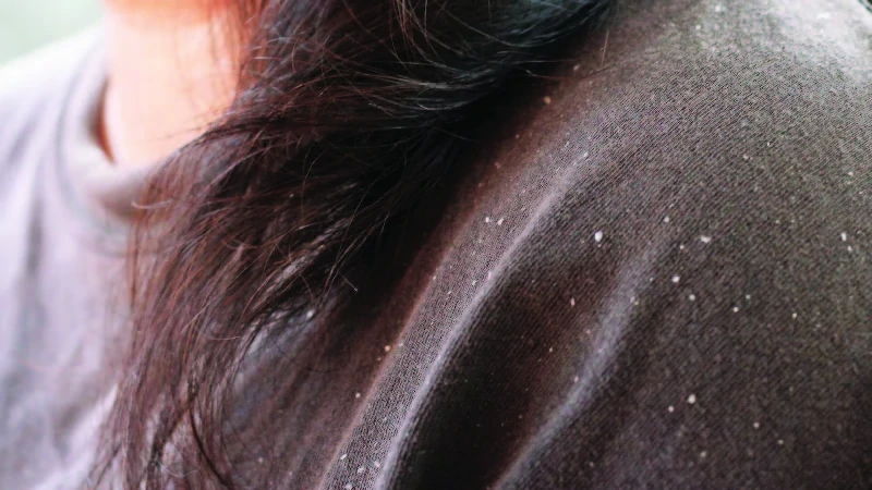 Dandruff image