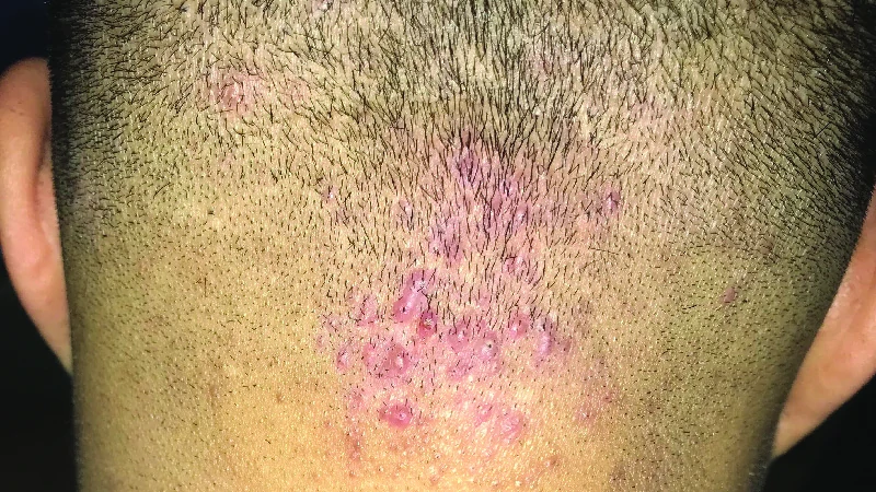 Folliculitis image