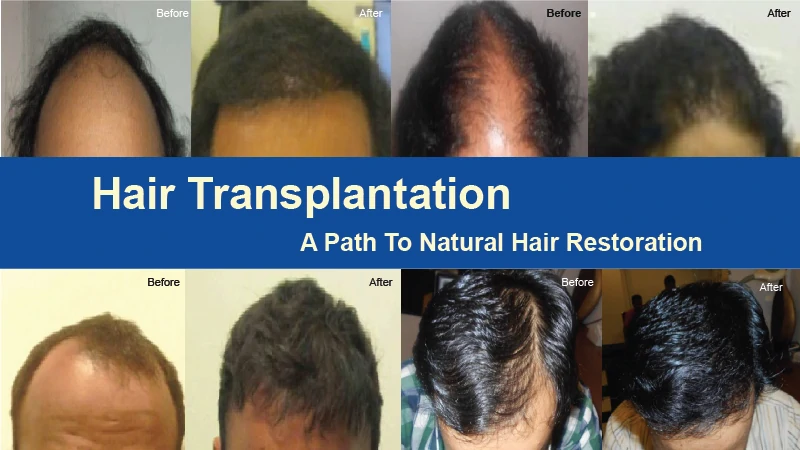 Hair transplant aftercare the most complete guide