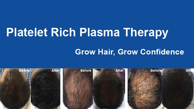 Get Best Hair Loss Treatment in Bangalore at Charma Clinic