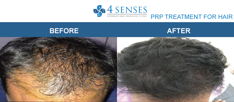 Permanent or Temporary PRP for Hair Loss Treatment  Cooley Hair Center