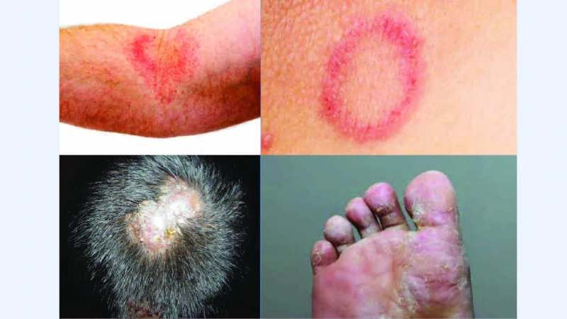 PPT - Ringworm fungal infection – Symptoms and Treatment PowerPoint  Presentation - ID:8185198