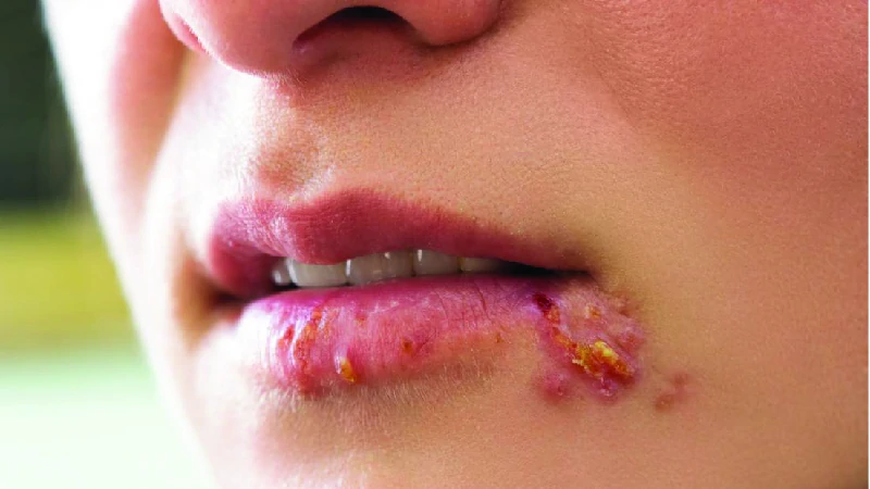 Acne Scars image