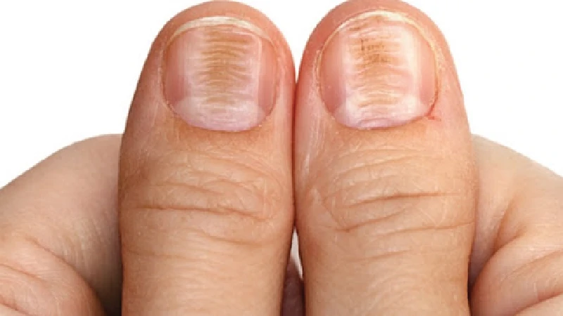 Nail Diseases Treatment in Bangalore | Nail Problems