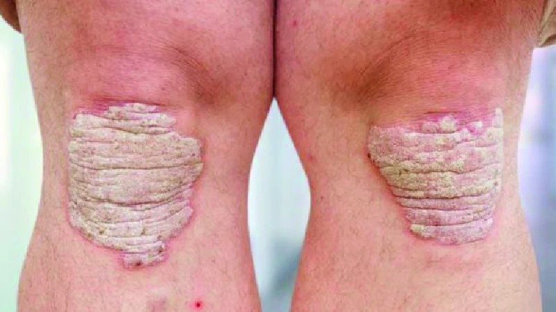 Psoriasis image