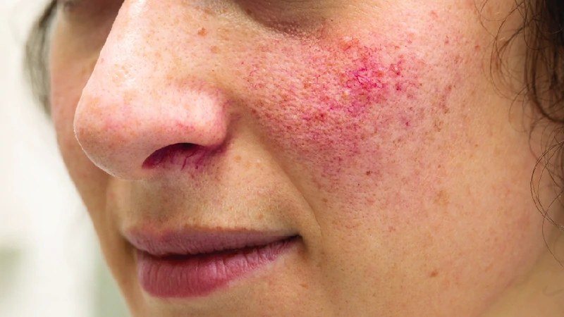 Rosacea image