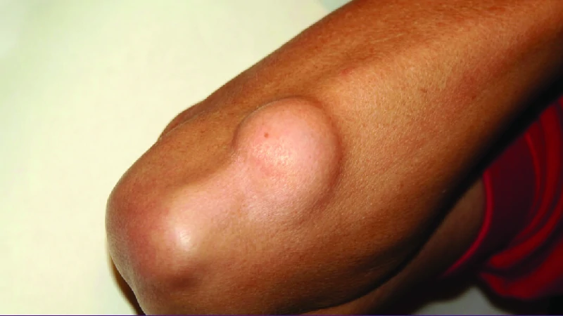 Skin Cancer image