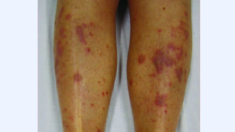 Lichen Planus image