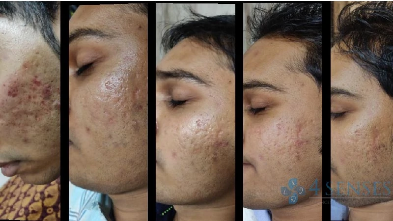 prp for skin image