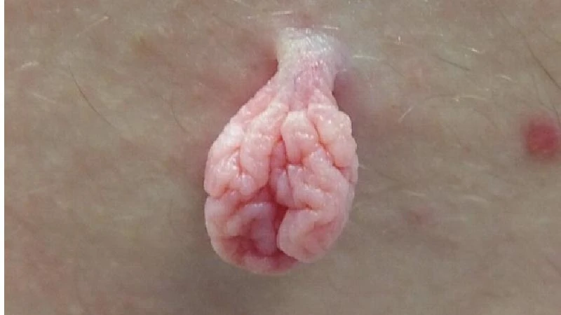 Skin Tags image