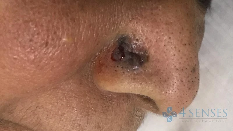 Skin Cancer image